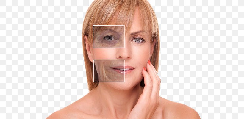 Plastic Surgery Wrinkle Medicine Botulinum Toxin, PNG, 640x400px, Surgery, Aesthetic Medicine, Bangs, Beauty, Blond Download Free