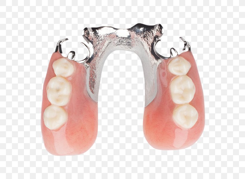 Human Tooth Dentures Removable Partial Denture Dentistry, PNG, 800x600px, Tooth, Allergy, Bone, Dentistry, Dentures Download Free