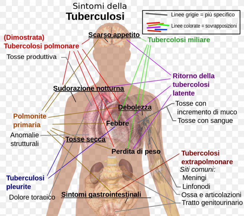 Tuberculosis Symptom Infection Infectious Disease, PNG, 1024x907px, Watercolor, Cartoon, Flower, Frame, Heart Download Free