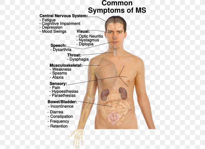 Multiple Sclerosis Signs And Symptoms Multiple Sclerosis Signs And Symptoms Medical Sign Disease, PNG, 504x596px, Watercolor, Cartoon, Flower, Frame, Heart Download Free