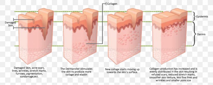 Collagen Induction Therapy Dermis Skin Care, PNG, 912x367px, Collagen Induction Therapy, Acne, Collagen, Cosmetics, Dermis Download Free