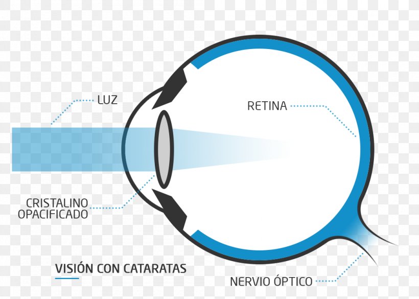 Floater Presbyopia Eye Far-sightedness Near-sightedness, PNG, 1050x750px, Floater, Blue, Brand, Communication, Diagram Download Free