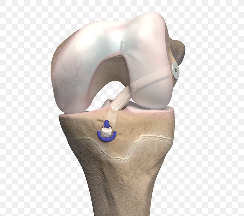Anterior Cruciate Ligament Reconstruction Bone, PNG, 720x726px, Anterior Cruciate Ligament, Bone, Cruciate Ligament, Hip, Jaw Download Free