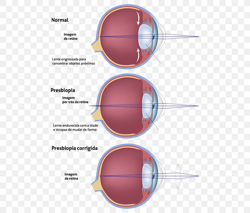 Presbyopia Progressive Lens Ophthalmology Near-sightedness, PNG, 506x700px, Presbyopia, Cataract, Cataract Surgery, Diagram, Eye Download Free