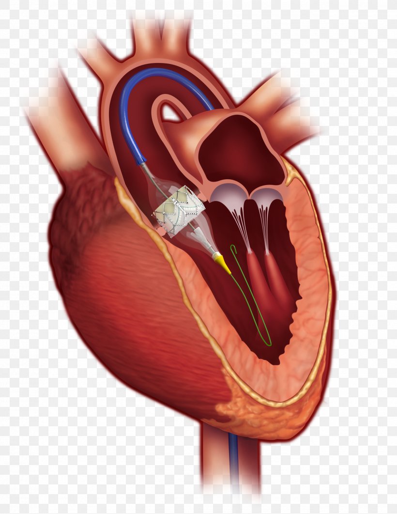 Percutaneous Aortic Valve Replacement Aortic Stenosis Heart Valve, PNG, 2550x3300px, Watercolor, Cartoon, Flower, Frame, Heart Download Free