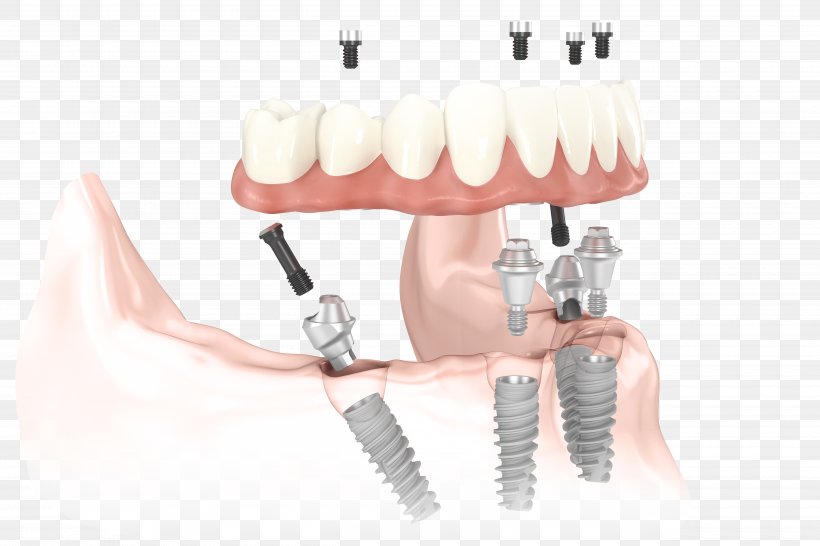 Dental Implant All-on-4 Dentistry Dentures, PNG, 5000x3333px, Dental Implant, Bridge, Cosmetic Dentistry, Dentist, Dentistry Download Free