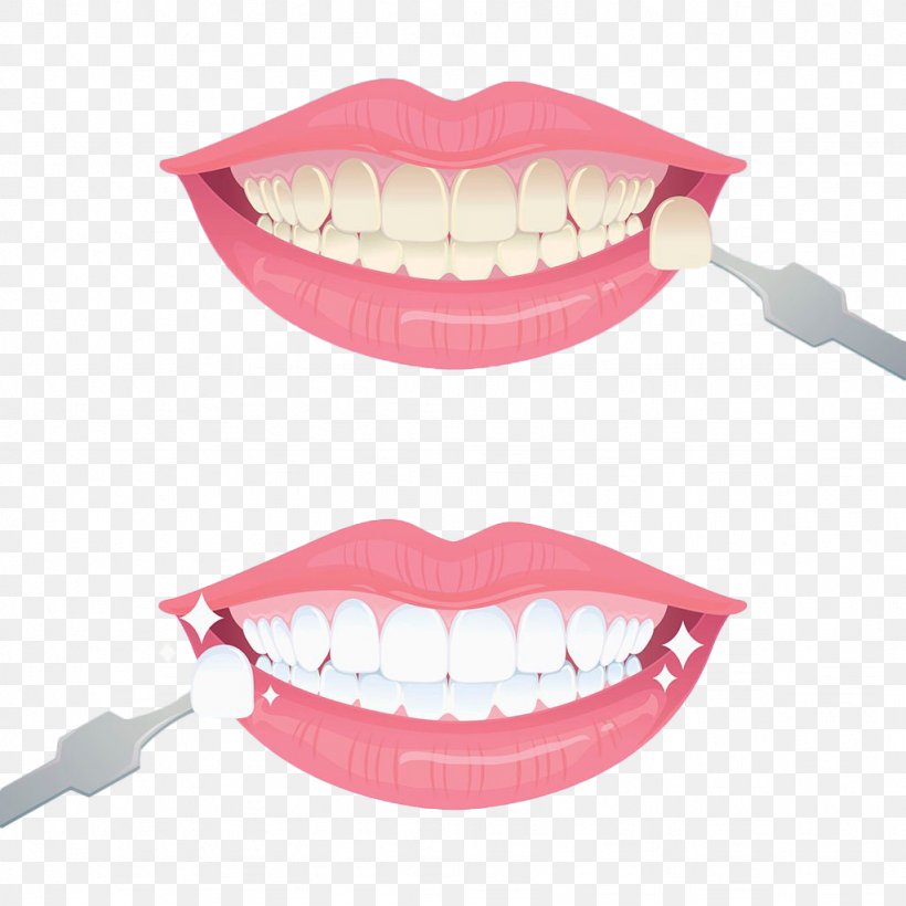 Tooth Whitening Euclidean Vector, PNG, 1024x1024px, Tooth, Dental Prosthesis, Dentistry, Face, Gratis Download Free