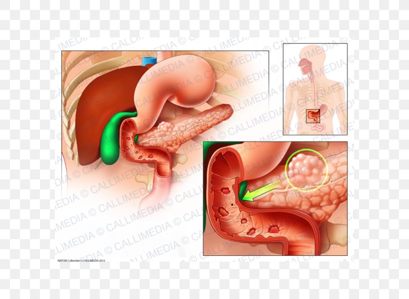 Zollinger–Ellison Syndrome Gastrinoma Peptic Ulcer Disease Symptom, PNG, 600x600px, Watercolor, Cartoon, Flower, Frame, Heart Download Free