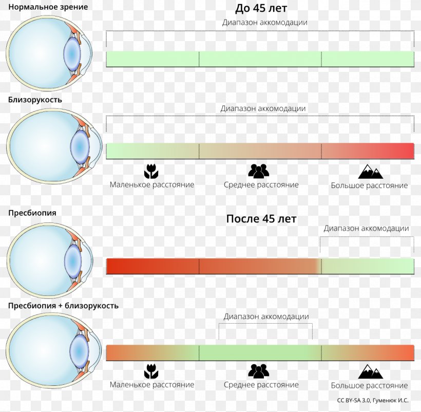 Excimer Laser Glasses Visual Perception Astigmatism Near-sightedness, PNG, 1267x1240px, Excimer Laser, Accommodation, Area, Astigmatism, Brand Download Free