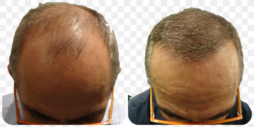 Follicular Unit Extraction Hair Transplantation Prohairclinic, PNG, 1200x600px, Follicular Unit Extraction, Chin, Clinic, Facial Hair, Forehead Download Free