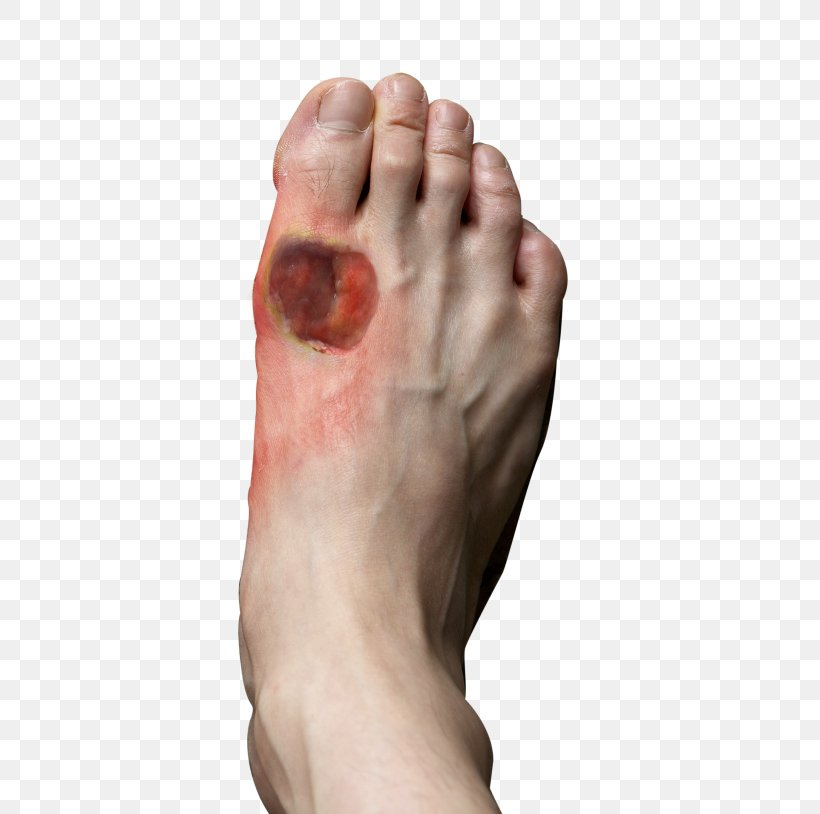 Diabetic Foot Ulcer Diabetes Mellitus Athlete's Foot, PNG, 532x814px, Watercolor, Cartoon, Flower, Frame, Heart Download Free