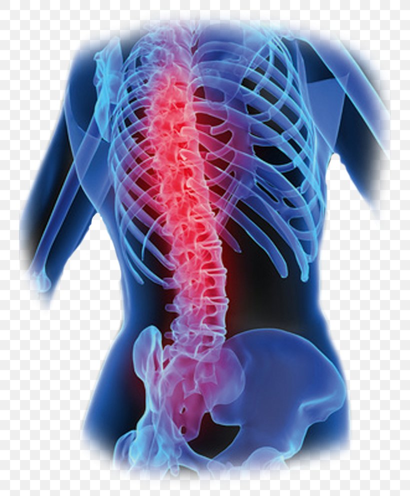 Low Back Pain Vertebral Column Bone Human Back, PNG, 744x992px, Back Pain, Bone, Coccyx, Human Back, Jaw Download Free