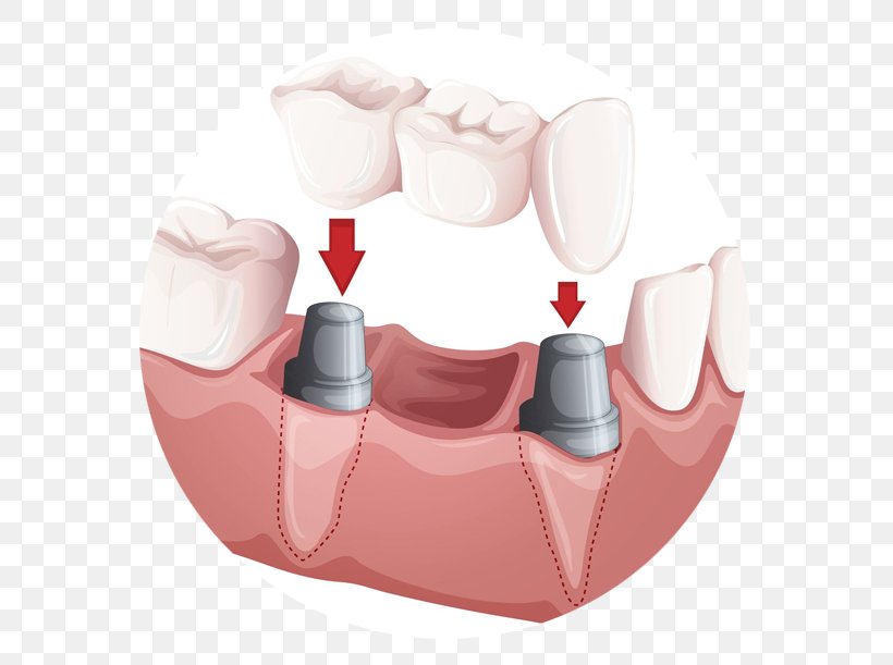 Bridge Dentistry Crown Dental Implant, PNG, 586x611px, Bridge, Cosmetic Dentistry, Crown, Dental Implant, Dental Restoration Download Free