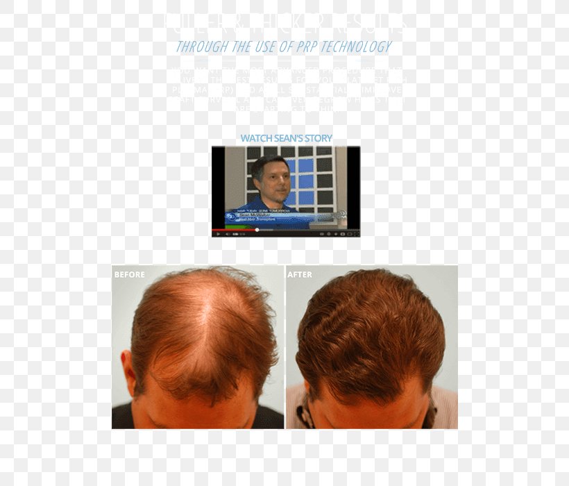 Hair Transplantation Lam Institute For Hair Restoration Eyebrow Hair Loss, PNG, 500x700px, Hair Transplantation, Chin, Cosmetics, Ear, Eyebrow Download Free