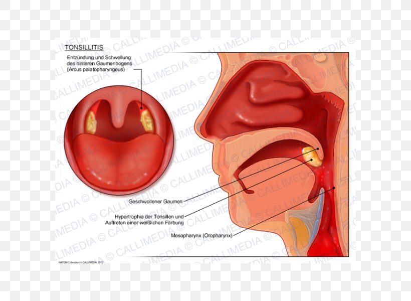 Tonsillitis Otorhinolaryngology Pharyngitis Oropharyngeal Cancer, PNG, 600x600px, Tonsillitis, Anatomy, Disease, Ear, Jaw Download Free