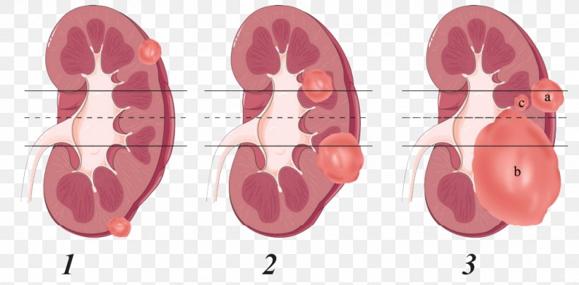 Kidney Tumour Nephrectomy Renal Cell Carcinoma Anatomy, PNG, 1035x511px, Watercolor, Cartoon, Flower, Frame, Heart Download Free