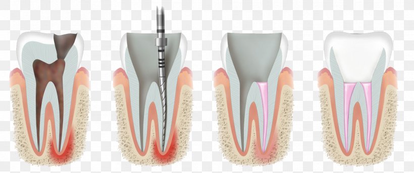 Endodontic Therapy Endodontics Dentistry, PNG, 1818x761px, Endodontic Therapy, Brush, Dentist, Dentistry, Endodontics Download Free