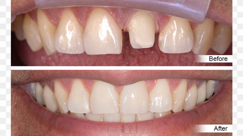 Crown Tooth Dentistry Dental Restoration, PNG, 825x464px, Crown, Amalgam, Bridge, Cadcam Dentistry, Ceramic Download Free