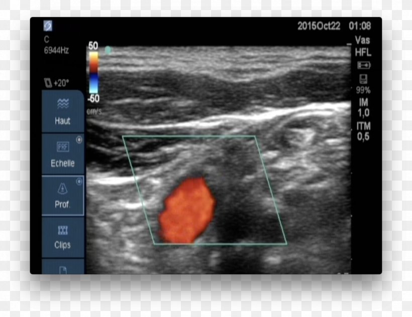 Medical Imaging Carotid Ultrasonography Doppler Echocardiography Ultrasound, PNG, 1534x1184px, Medical Imaging, Biomedical Engineering, Blood, Carotid Ultrasonography, Color Download Free