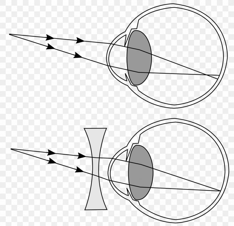 Near-sightedness Hypermetropia Refractive Error Presbyopia Eye, PNG, 1057x1024px, Nearsightedness, Abbildungsfehler, Accommodation, Area, Artwork Download Free