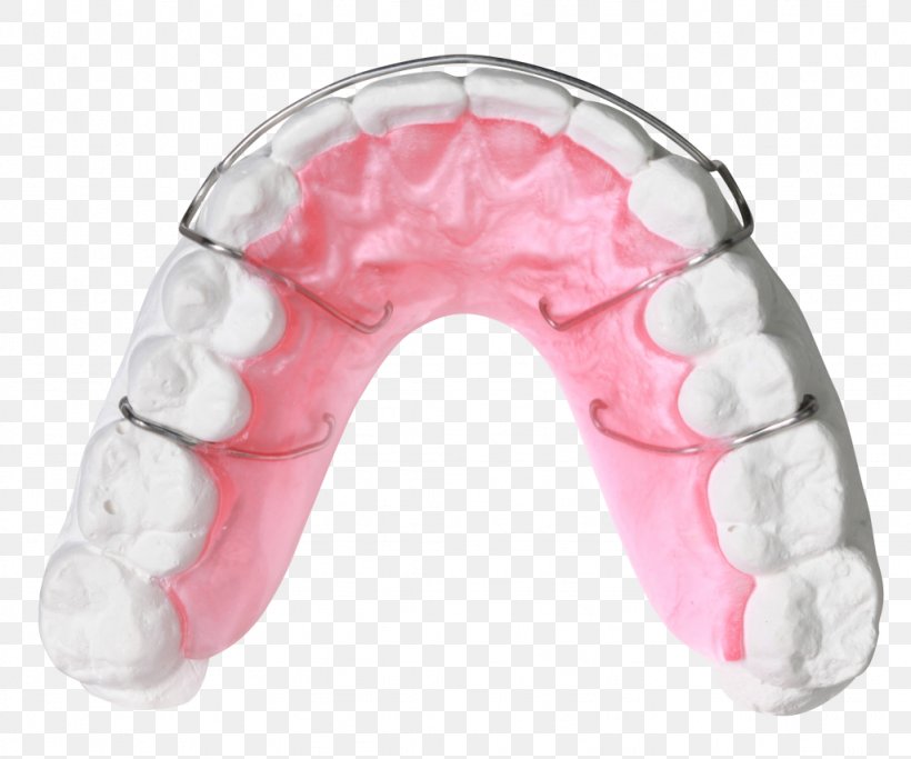 Orthodontics Orthodontic Technology Jaw Quad Helix Dentistry, PNG, 1024x854px, Orthodontics, Apnea, Bionator, David Gergen, Dentistry Download Free