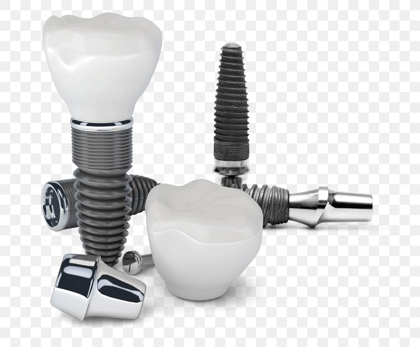 Dental Implant Cosmetic Dentistry, PNG, 700x678px, Dental Implant, Clinic, Cosmetic Dentistry, Crown, Dental Surgery Download Free