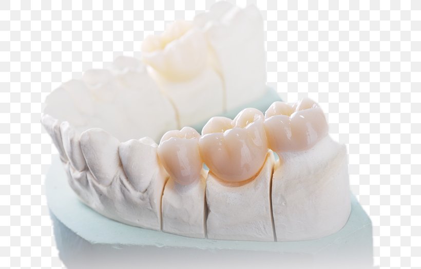 Dentistry Jaw Dental Restoration Zirconium Dioxide Wholesale, PNG, 661x524px, Dentistry, Alibaba Group, Buttercream, Cleaning, Consumables Download Free