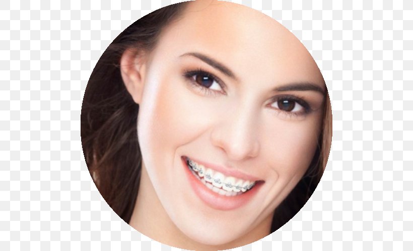 Dental Braces Orthodontics Dentistry Tooth, PNG, 500x500px, Dental Braces, Beauty, Brown Hair, Cheek, Chin Download Free