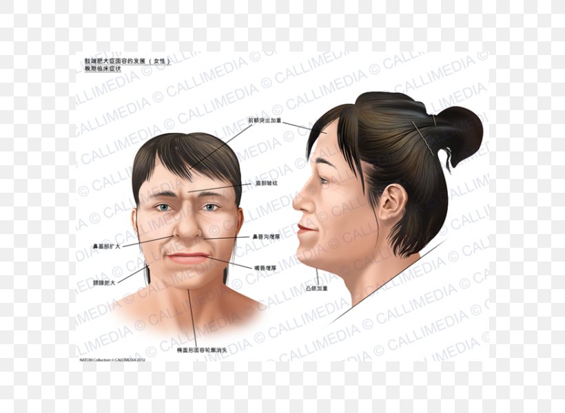 Acromegaly Face Symptom Gigantism Skull Bossing, PNG, 600x600px, Acromegaly, Cheek, Chin, Ear, Endocrinology Download Free