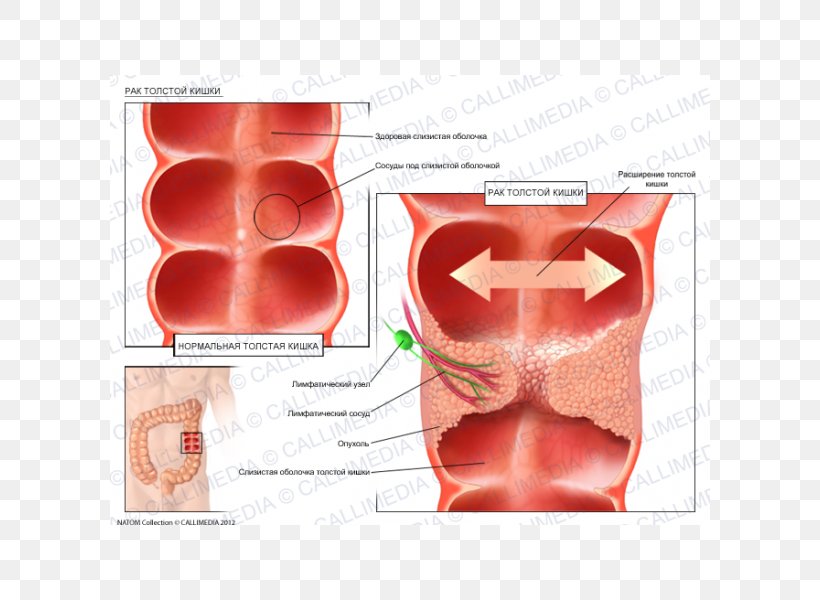 Illustration Anatomique Ductal Carcinoma In Situ Oncology, PNG, 600x600px, Watercolor, Cartoon, Flower, Frame, Heart Download Free