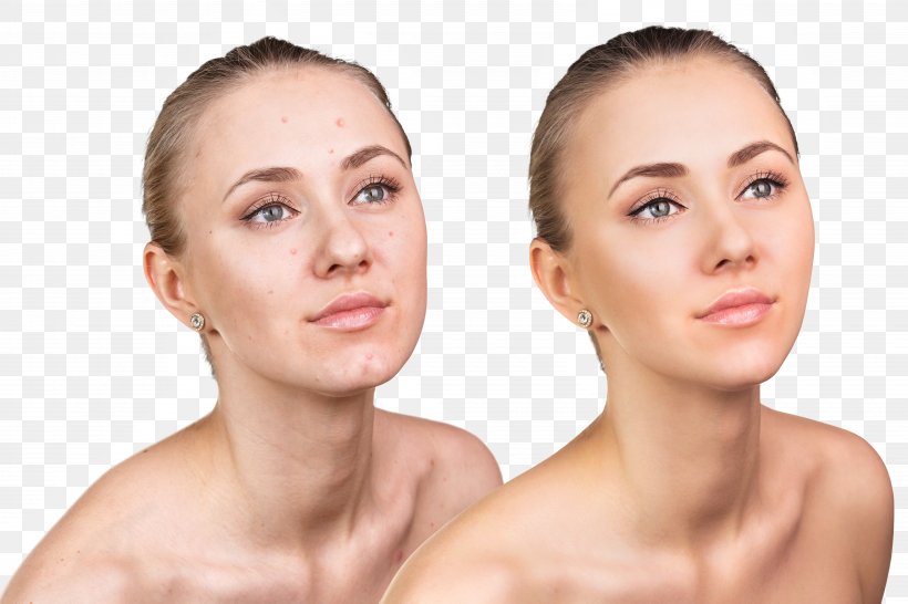 City Magnolia Day Spa Skin Face Cosmetics Acne, PNG, 5760x3840px, City Magnolia Day Spa, Acne, Beauty, Cheek, Chin Download Free