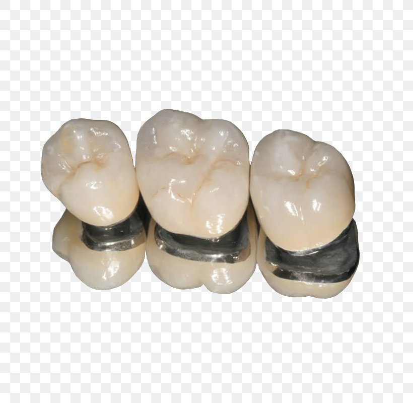 Crown Dentistry Bridge Ceramic, PNG, 800x800px, Crown, Alloy, Bridge, Ceramic, Cosmetic Dentistry Download Free