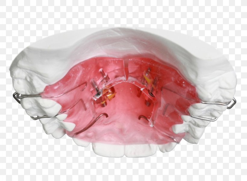 Orthodontics Sagittal Plane Orthodontic Technology Jaw Retainer, PNG, 1024x750px, Orthodontics, Bionator, Clear Aligners, David Gergen, Dentistry Download Free