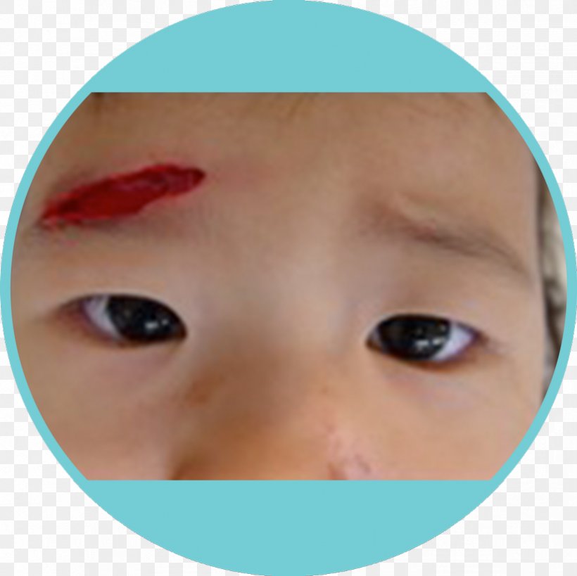 Wound Healing Therapy Skin, PNG, 824x823px, Wound Healing, Cheek, Child, Chin, Close Up Download Free