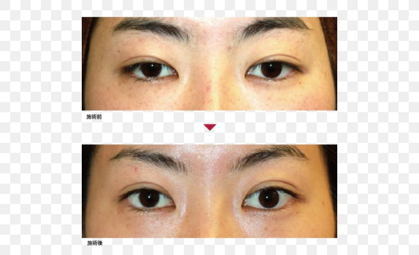 Eyebrow Eyelid Eyelash Extensions Primo Azabujuban Clinic, PNG, 500x500px, Eyebrow, Cheek, Chin, Cosmetics, Eye Download Free