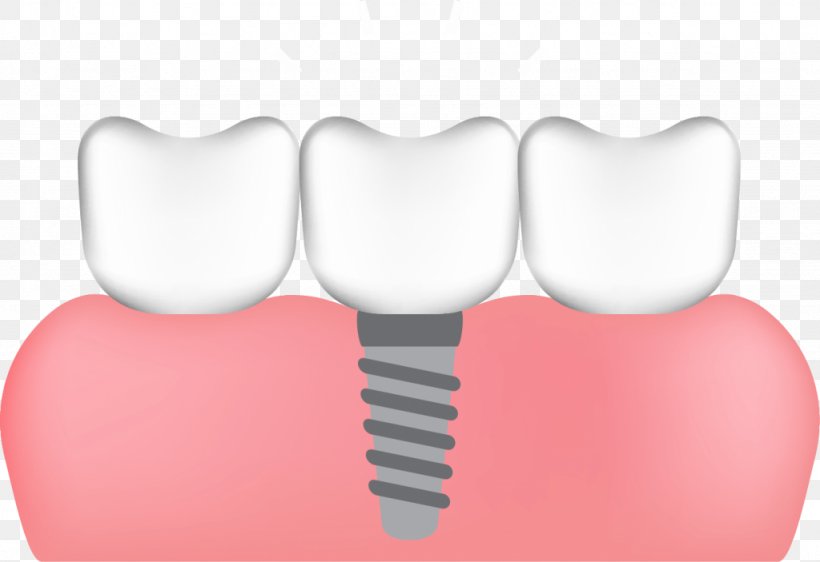 Human Tooth Dental Implant All-on-4, PNG, 1024x703px, Tooth, Ahmedabad, Allon4, Bone, Bone Grafting Download Free