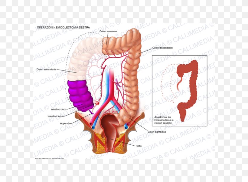 Colectomy Surgery Large Intestine Colorectal Cancer Human Digestive System, PNG, 600x600px, Watercolor, Cartoon, Flower, Frame, Heart Download Free
