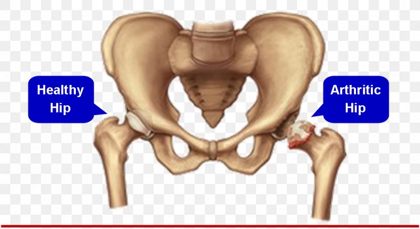 Hip Replacement Joint Replacement Surgery Knee Replacement, PNG, 1069x585px, Watercolor, Cartoon, Flower, Frame, Heart Download Free