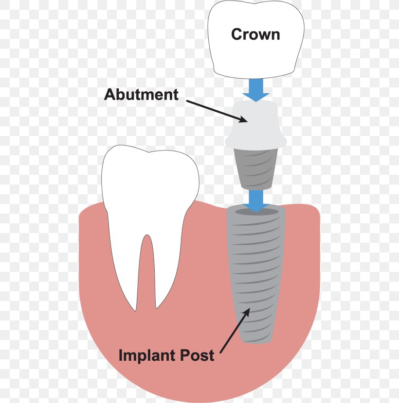 Tooth Dental Implant Dentistry Dentures, PNG, 496x830px, Watercolor, Cartoon, Flower, Frame, Heart Download Free