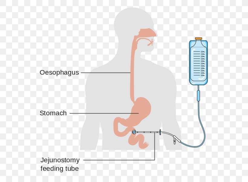Jejunostomy Feeding Tube Percutaneous Endoscopic Gastrostomy Nasogastric Intubation, PNG, 603x600px, Watercolor, Cartoon, Flower, Frame, Heart Download Free