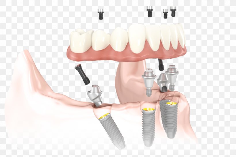 All-on-4 Dental Implant Dentistry Dentures, PNG, 1200x800px, Dental Implant, Cosmetic Dentistry, Dentist, Dentistry, Dentures Download Free