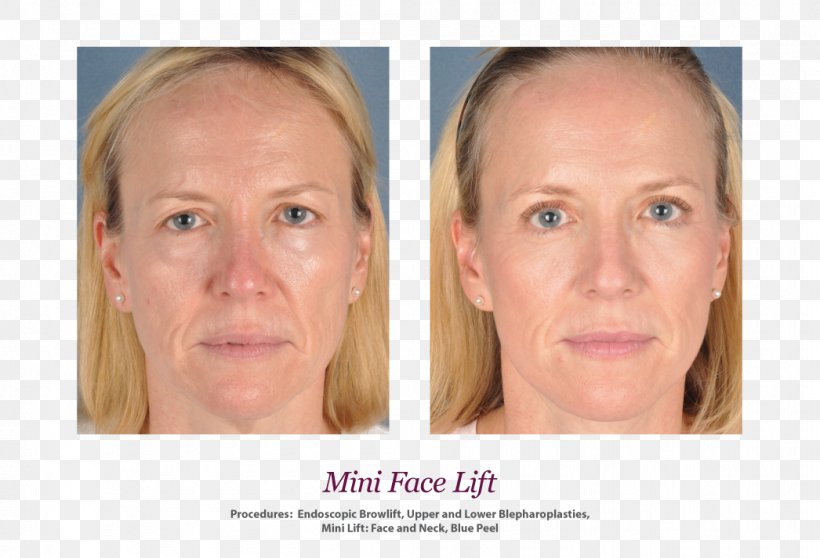 Skin Face Rhytidectomy Wrinkle Surgery, PNG, 1046x713px, Skin, Cheek, Chin, Collagen, Dermatology Download Free