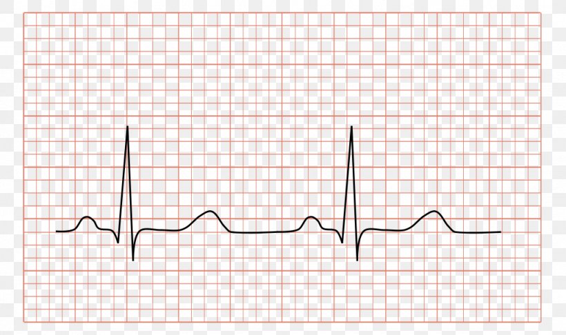 Electrocardiography QRS Complex Medicine Cardiology Heart, PNG, 1024x607px, Watercolor, Cartoon, Flower, Frame, Heart Download Free