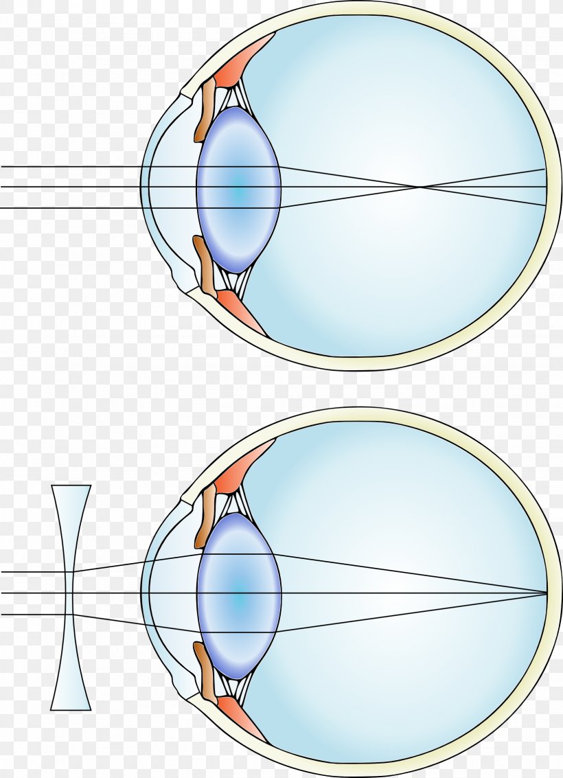Near-sightedness Hypermetropia Corrective Lens Eye, PNG, 1634x2259px, Nearsightedness, Accommodation, Area, Astigmatism, Contact Lenses Download Free