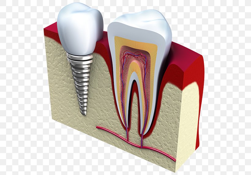 Dental Implant Dentistry Tooth Surgery, PNG, 535x572px, Watercolor, Cartoon, Flower, Frame, Heart Download Free