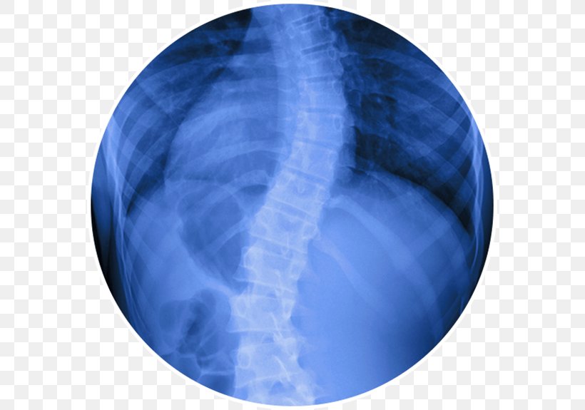 Scoliosis Vertebral Column Surgery Therapy Back Pain, PNG, 575x575px, Scoliosis, Back Brace, Back Pain, Blue, Cobalt Blue Download Free