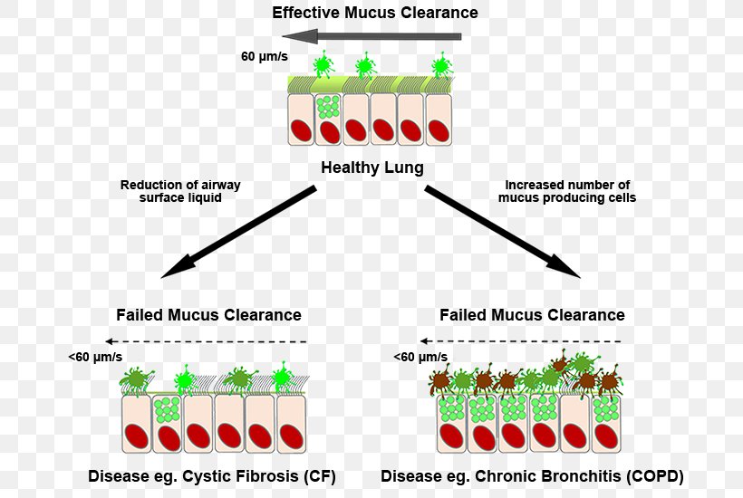 Lung Mucus Cystic Fibrosis Respiratory Disease Asthma, PNG, 696x550px, Lung, Area, Asthma, Bronchitis, Chronic Bronchitis Download Free