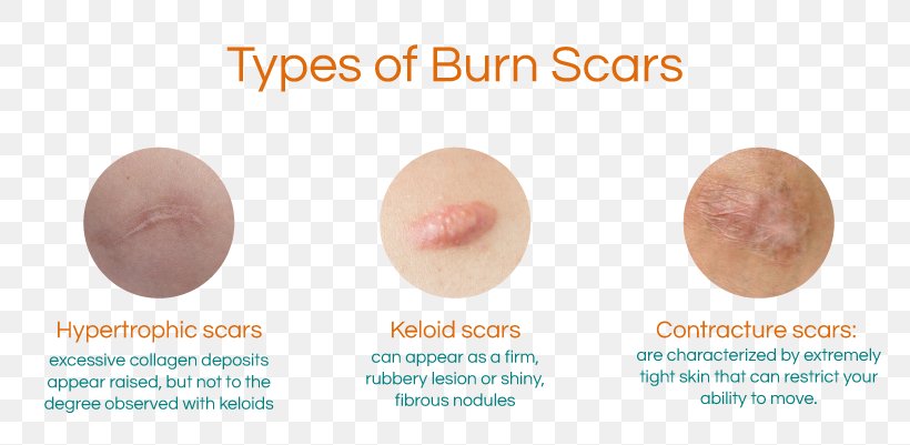 Burn Scar Contracture Hypertrophic Scar Keloid, PNG, 801x401px, Scar, Acne, Aloe Vera, Burn, Burn Scar Contracture Download Free