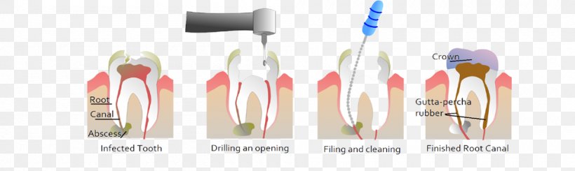 Endodontic Therapy Root Canal Dentistry, PNG, 1000x300px, Endodontic Therapy, Brush, Cutlery, Dental Extraction, Dental Implant Download Free