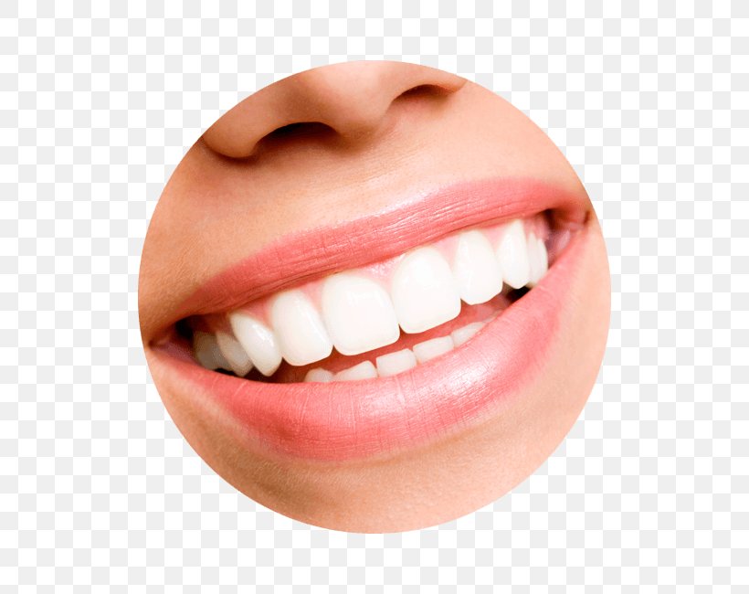 Tooth Whitening Cosmetic Dentistry Veneer, PNG, 650x650px, Tooth Whitening, Chin, Close Up, Cosmetic Dentistry, Dental Bonding Download Free